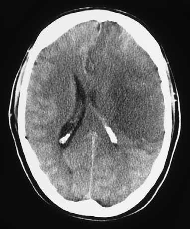 Figuur 1. CT-scan van een ruimte-innemend herseninfarct van een 48-jarige man 24 uur na het ontstaan van een hemiparese rechts en afasie. Figuur 2.
