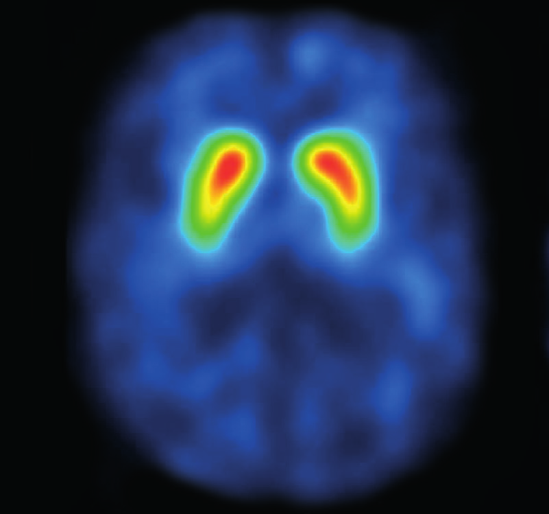 DAT-scan van een persoon zonder parkinson. DAT-scan van een patiënt met parkinson. WELKE BEHANDELINGEN BESTAAN ER?