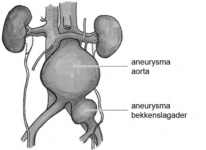 Onderzoek naar aneurysma s Genetici van vijf Nederlandse universiteiten hebben samen een erfelijke oorzaak gevonden voor het ontstaan van verwijdingen in de aorta.