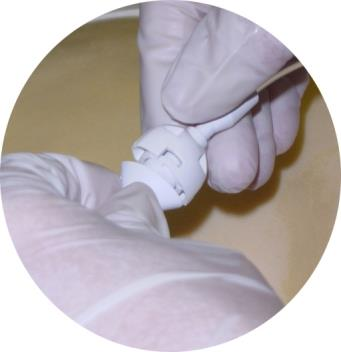 Het uiteinde van de Rocket Pleural catheter kan met een speciale set bevestigd worden op de huid zodat er geen tractie op de Rocket Pleural catheter kan ontstaan en deze geen drukplekken geeft. Fig.