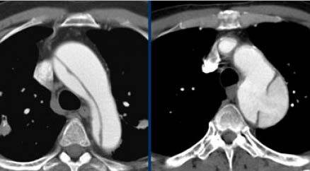 ECG geen meerwaarde, tenzij coronairen betrokken RX thorax: verbreed mediastinum (>3mm tussen