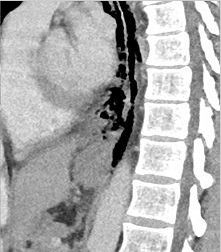 nekpijn of epigastrische pijn