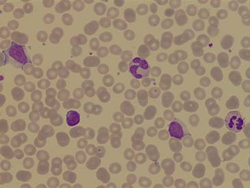 Hb 7.7 mmol/l; neutro s 48% lymfo s 42% mono s 8% eo s 1% baso s 0.5% Vraagstelling: Aanwijzingen hematologische maligniteit?