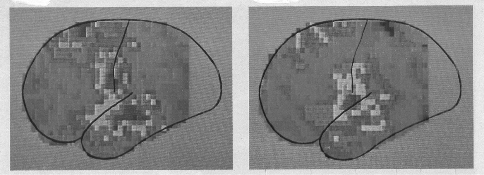 De eerste funktionele hersenscans (PET-scans) stammen uit 1978 en laten dit principe overduidelijk zien. Figuur 4: De eerste PET-scans. Boven: hardop tellen, linker en rechter hemisfeer.