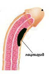 Wat is de ziekte van Peyronie? De ziekte van Peyronie is een goedaardige afwijking van de penis met onbekende oorzaak.