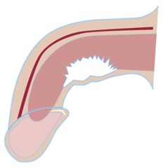 Mogelijke oorzaken De oorzaak is vorming van een streng bindweefsel in een zwellichaam, waardoor de penis daar niet in gelijke mate mee kan rekken als in het andere zwellichaam.