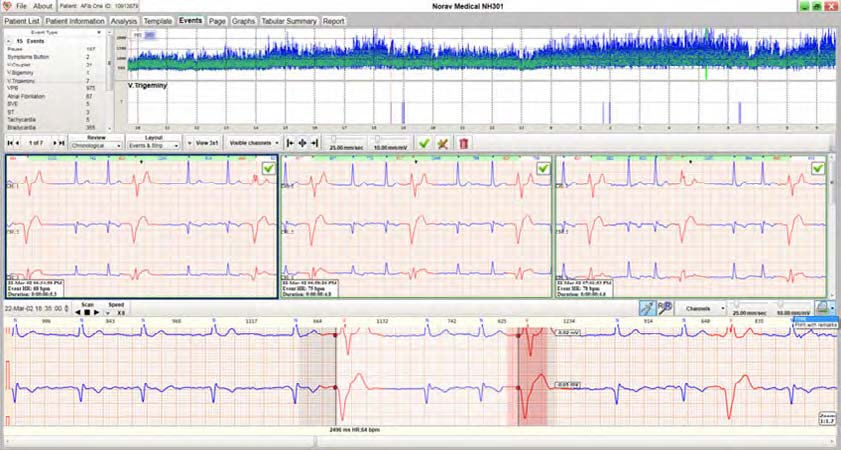 Holter ECG Norav NH-301 Holter ECG - Holter analyse software NH-301 Holter ECG Software Gebruiksvriendelijk met intuïtieve interface en duidelijke informatie op het scherm