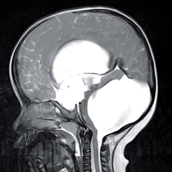 Een MRI-plaatje van een twee-jarig jongetje met een verstandelijke beperking.