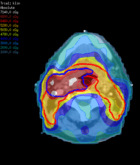 Uitgebreidere tests: oropharynx IMRT