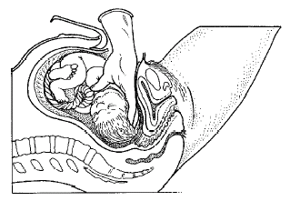 Fig. 1: de geboorte van uw kind bij een keizersnede Als uw kind geboren is, wordt de navelstreng doorgeknipt.