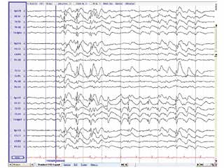 Tijdens epileptische aanvallen treden in de hersenen ontladingen op die meestal in het EEG te zien zijn als pieken of piekgolven.