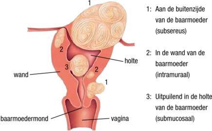 In deze folder geven we u uitleg over wat myomen zijn, het onderzoek naar myomen en de eventuele behandeling van myomen. Wat zijn myomen?