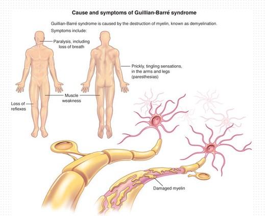 Guillain-Barrésyndroom (GBS) Immuunstoornis waarbij perifere zenuwstelsel wordt aangetast Infectie Vaccinatie Operatie Zeldzame