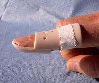 Behandeling Er zijn twee manier om een mallet finger te behandelen: niet-operatief en operatief. Niet-operatieve behandeling: Mallet-spalk Meestal kan een mallet finger met een spalk behandeld worden.