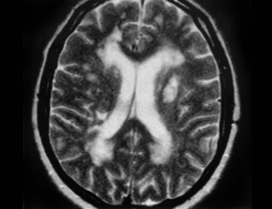 Figuur 1. Karakteristiek MR-beeld van CADASIL bij een 45-jarige patiënt.