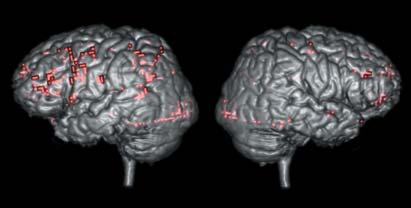 Figuur 2. fmri-activiteit (rood) gevisualiseerd op een linker (A) en rechter (B) corticaal aanzicht bij een patiënt met volgens de Wada-test, een links dominante hemisfeer voor taal.