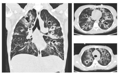 68-jarige man N=110 N=92 N=41 N=78 N=12 N=3 30-day mortality Albumin OR 0.34 (0.13-0.86) PSI score OR 1.03 (1.01-1.044) Initial treatment failure OR 72.1 (21.9-236.7) Maruyama T.