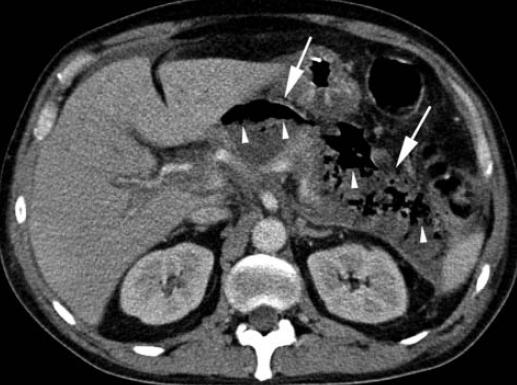Infected necrosis Extraluminal gas in pancreatic- and