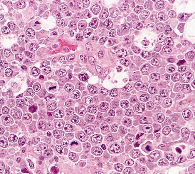 Diffuse Large Cell Lymphoma (DLBCL) Older patients and HIV infected patients Disseminated in many lymph nodes or extra-nodal Diffuse pattern in HE