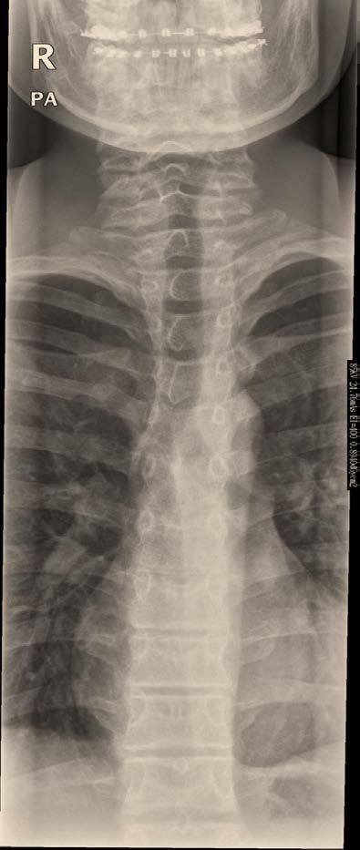 Anatomie 7 nekwervels Functioneel bewegen tot tussen de schouderbladen Veel spieren om het