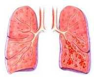 COPD in een notendop COPD is een aandoening welke gekenmerkt wordt door een luchtwegobstructie welke niet volledig reversibel is.
