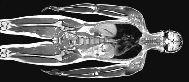 het in principe de ideale kandidaat voor de beeldvorming van het beenmerg. 18 MRI visualiseert focale 19, 20 of diffuse myeloom infiltratie van het beenmerg met hoge sensitiviteit en specificiteit.