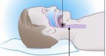 In deze folder vindt u algemene informatie over het slaapapneusyndroom en de behandeling daarvan met een CPAP-apparaat.