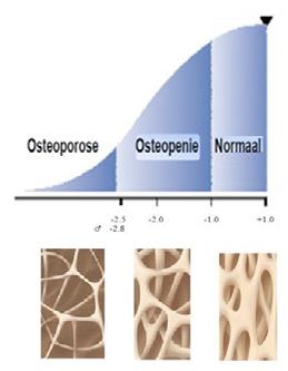 Hoe weet ik of ik osteoporose heb? Osteoporose kan alleen zichtbaar gemaakt worden door de botdichtheid te meten. Dat gebeurt door middel van een zogenaamde DXA-meting.