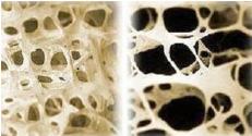 Wat is osteoporose Osteoporose betekent poreus bot. Het is een aandoening waarbij het bot langzaam steeds meer botweefsel verliest. Hierdoor verliest het bot zijn stevigheid.
