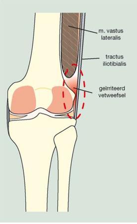 Zo n 10% van alle hardloopblessures wordt door de Runners Knee veroorzaakt en kenmerkt zich door pijn aan de buitenzijde van de knie welke geprovoceerd wordt door de knie 30 te buigen.