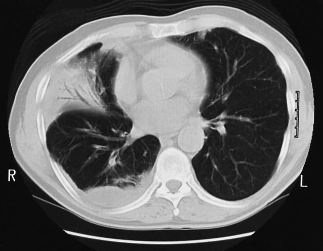 middenkwab figuur 2. CT-scan met hoge resolutie van patiënt B: dorsaal in de onderkwab en in de middenkwab dichte consolidatie met luchtbronchogram.
