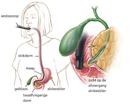 De positie van de endoscoop tijdens een ERCP-onderzoek (bron: www.hopkins-gi.org) Ingrepen tijdens het onderzoek Mogelijk doet de MDL-arts tijdens het onderzoek een ingreep.