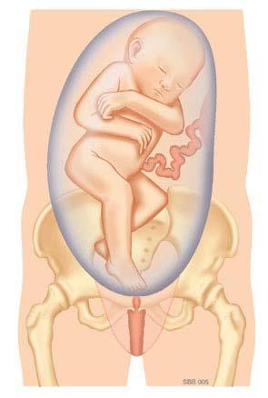 Bij een stuitligging ligt het hoofd van het kind boven in de baarmoeder, terwijl de billen (onvolkomen stuitligging) of de benen (volkomen stuitligging) beneden bij de ingang van het bekken liggen