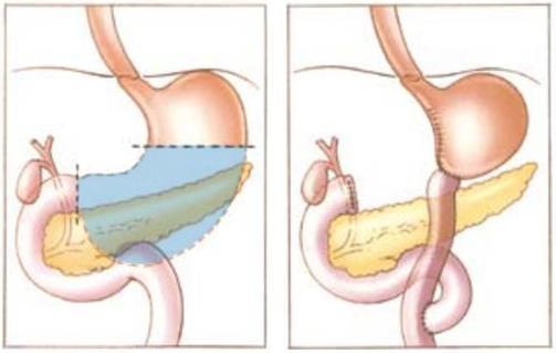 Bron: KWF kankerbestrijding Bij een totale maagresectie wordt de hele maag verwijderd en wordt de kringspier aan de onderzijde van de maag (pylorus) weggenomen.