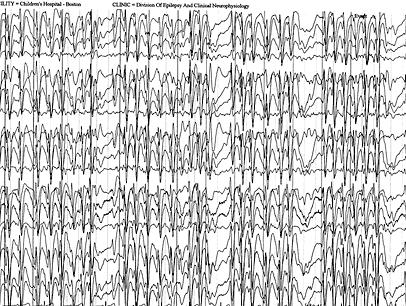 Landau-Kleffner syndroom Epilepsiesyndroom gekenmerkt door: Electrical status epilepticus in slow-wave-sleep (ESES) Cognitieve stoornissen, cognitieve regressie meest uitgesproken op vlak