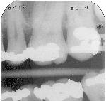 Van de ongeveer zes miljoen röntgenfoto s die tandartsen in 1996 maakten, bestond ten minste twee derde uit bitewing-röntgenopname.