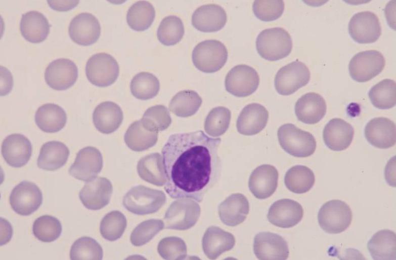 lymfocytes (<10%) Atypische