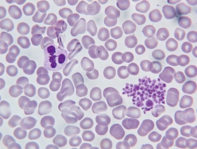 Bloedplaatjesaggregaten, vals verlaagd aantal thrombocyten EDTA