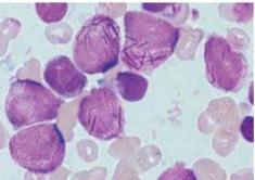 Acute promyelocytaire leukemie met PML/RARA Morfologie :