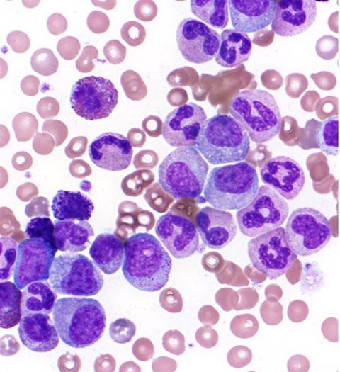 Myeloproliferatieve aandoeningen Chronische myeloïde leukemie Morfologie : PB