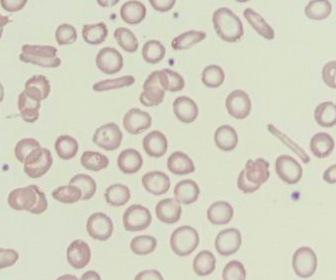 synthese/hypochromasie (MCHC ) ferriprieve anemie