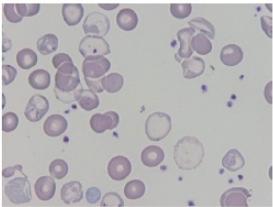 thalassemie (target cells, basofiele stippeling )