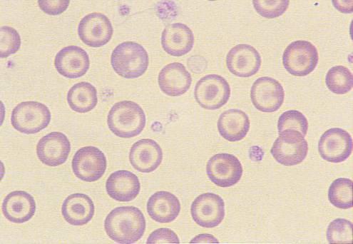 Fragmentocyten TTP/HUS DIC