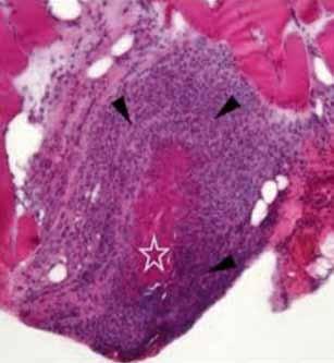 6 Tabel 3. Prognostische factoren volgens de five factor-score (FFS) (1996). 19 1. proteïnurie > 1g/dag 2. creatininespiegel > 140 µmol/l 3. cardiomyopathie 4. gastroïntestinale aantasting 5.