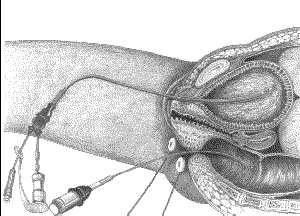 In de figuur ziet u de binnenkant van het onderlichaam van een vrouw. In de blaas en het uiteinde van de dikke darm zijn kathethers (dunne slangetjes) geschoven.