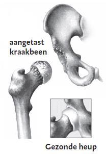 Heup met artrose Bouw en functie van het heupgewricht Het heupgewricht is een kogelgewricht. Als u loopt en beweegt draait de kop van uw dijbeen soepel rond in de kom van uw bekken.