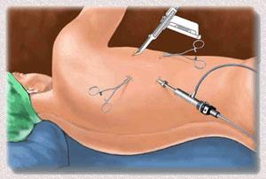 Inleiding VATS is een afkorting van een engels begrip: Videoscopic Assisted Thoracic Surgery.