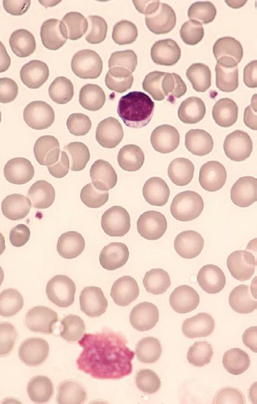 Leerpunten De monoklonale B-cellymfocytose (MBL) is recentelijk voorgesteld als premaligne voorstadium van de chronische lymfatische leukemie (CLL).
