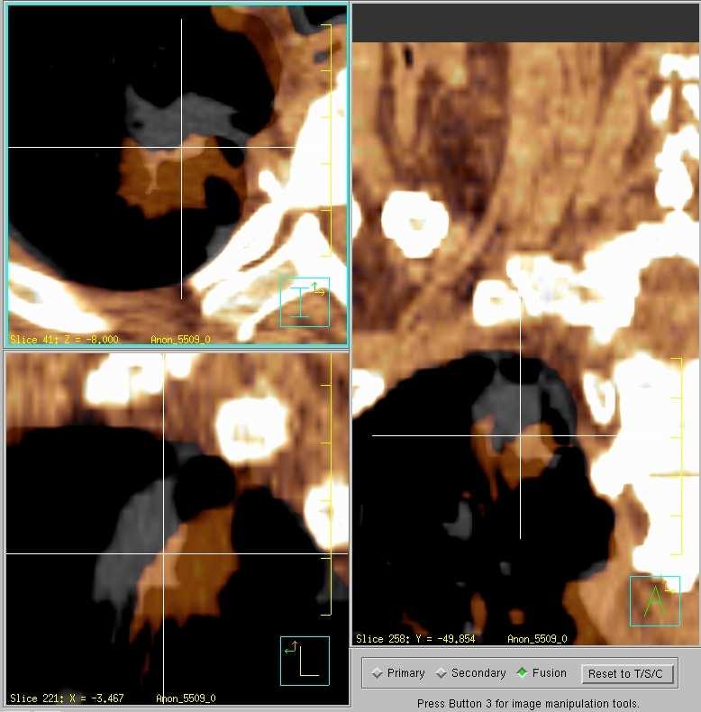 3. Voorbereiding: 4D - CT