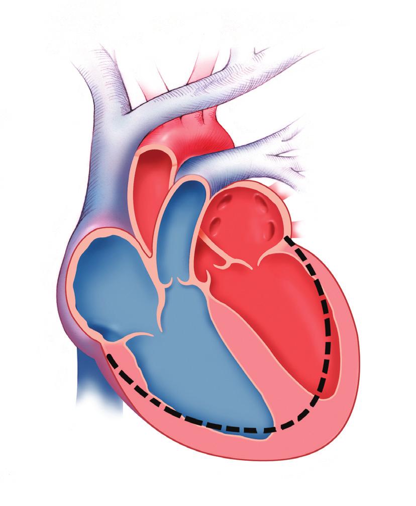 Hartfalen Het hart kan om een aantal redenen beginnen te falen. Een reden kan het gevolg zijn van spierbeschadiging door een hartaanval.